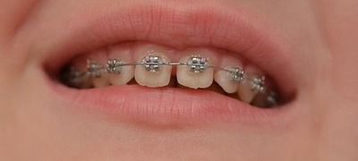 Надкусочные пломби при брекетах, ставлять на пломбовані, нарощені зуби, можна поставити, якщо є імплант або коронка