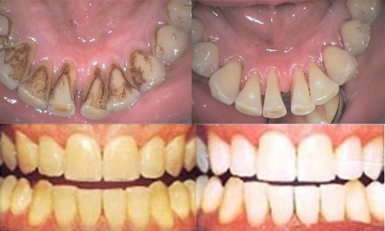 Показання до застосування механічного відбілювання зубів, види відбілювання.