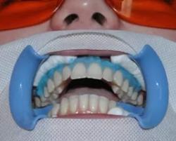 Відбілювання зубів ультразвуком, переваги та недоліки методу