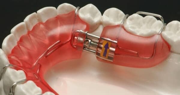 Ретейнери після брекетів: дріт на зуби, навіщо треба ставити, скільки потрібно носити, як відбувається установка і зняття, фото