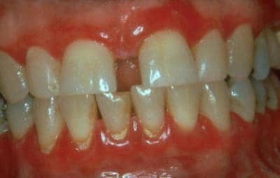 Після відбілювання зубів болять зуби: чому і як довго, що робити, якщо почалася зубний біль, ніж зняти, чи боляче полоскати