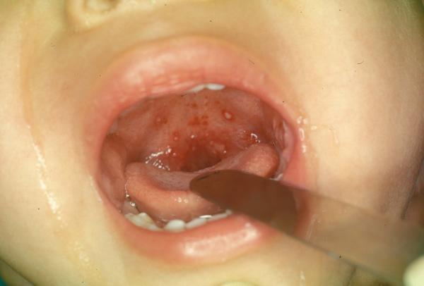Як відрізнити стоматит від ангіни: в чому відмінності одночасно протікає або після герпесной хвороби у дитини, фото з поясненням