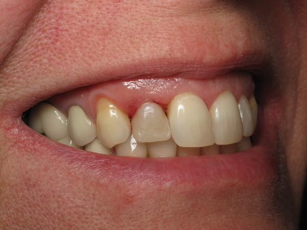 Коли знімають шви після імплантації зубів: на який день це можливо, через скільки часу заживе, як лікувати якщо розійшлися