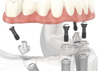 Протезування зубів на імплантатах і без, види зубних протезів: мостоподібний і балковий, плюси і мінуси, чим відрізняється імплантація