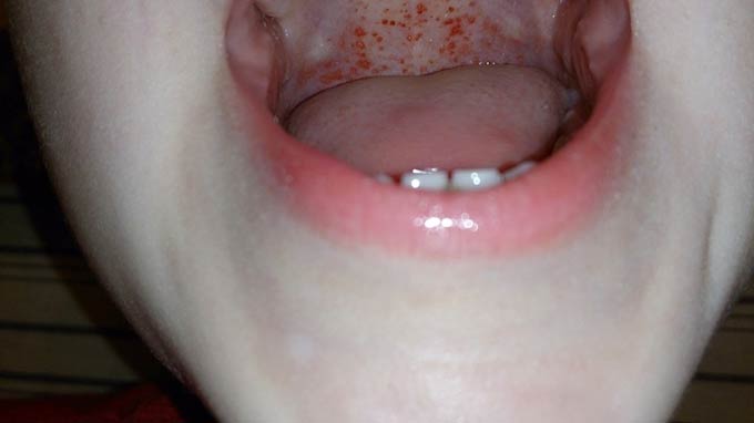 Точки в роті (червоні, білі, чорні), енантема у дорослих, лікування