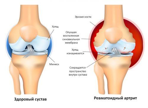 Симптоми, діагностика та терапія артриту колінного суглоба