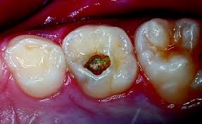 Глибокий карієс зубів. Діагностика та лікування глибокої форми карієсу.