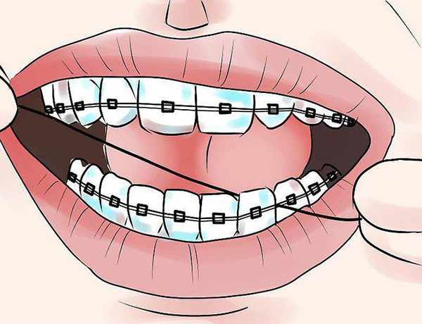 Як правильно чистити зуби з брекетами електричною зубною щіткою, чистка ниткою: чи можна після відбілити у стоматолога?