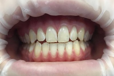 Відбілювання зубів Zoom 4 і 3, вартість системи Зум в клініці, як виглядає емаль після процедури, використання апарату Philips