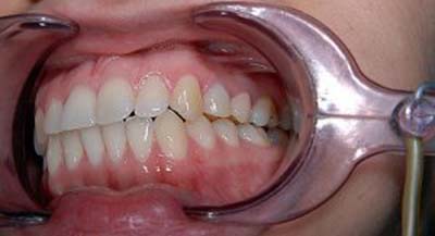 Експрес імплантація зубів: через скільки після видалення можна одночасно ставити імплант, коли по часу, відразу установка