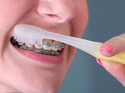 Як правильно чистити зуби з брекетами електричною зубною щіткою, чистка ниткою: чи можна після відбілити у стоматолога?