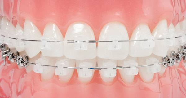 Брекети на нижню щелепу: чи можна поставити тільки одну, фото зубів до і після установки керамічних, навіщо ставити системи