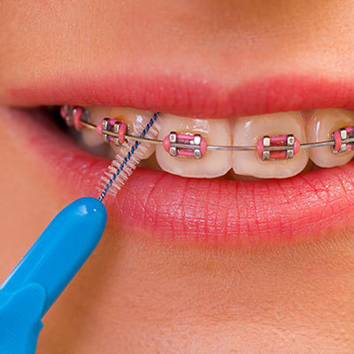 Йоржики для брекетів: як правильно чистити зуби, що краще для чищення, ортодонтичні Oral B, Cupaprox або електричні щіточки