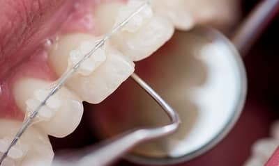 Для чого потрібні брекети, що це таке, навіщо вони в лікуванні, виправляють чи щілини між кривими зубами, допоможуть вирівняти їх
