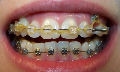 Чи можна ставити брекети, якщо немає одного зуба або не вистачає кількох і як при відсутності ставлять гвинти в щелепу для фіксації