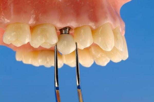 Що краще: коронка або імплант, їх встановлення та імплантація, на які зуби варто ставити, як вони кріпляться