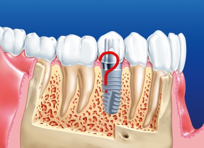 Протипоказання до імплантації зубів, можливі ускладнення для установки зубних імплантантів при пародонтозі, цукровому діабеті, ВІЛ