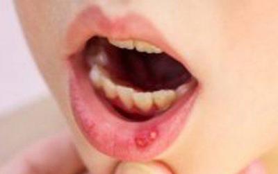 Стоматит на губах у дорослих: на внутрішній стороні, фото нижній, ніж лікувати, всередині в носі як вилікувати, ніж припекти у роті