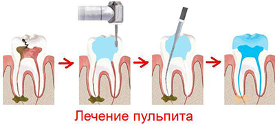 Запущений карієс: наслідки та лікування зуба, що робити, якщо вже сильний і великий вогнище ураження