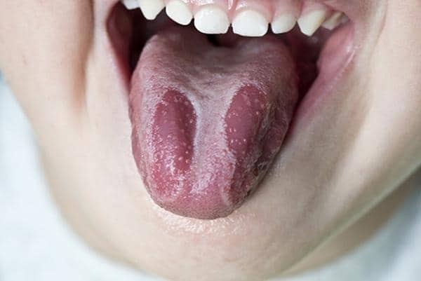 Перекис водню при стоматиті у дорослих, лікування полосканням, як полоскати рот, можна обробляти у дітей
