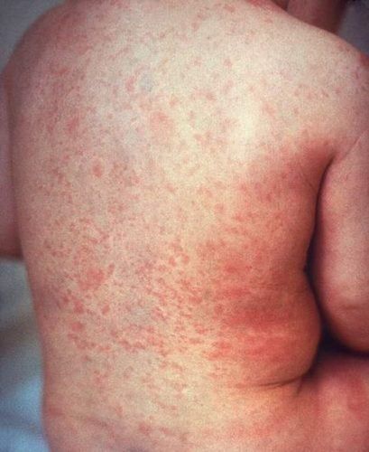 Причини, симптоми та лікування пелюшкового дерматиту