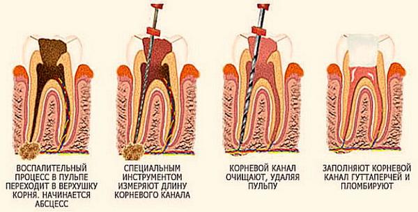 Гнійний пульпіт: лікування цієї гострої форми хвороби зуба