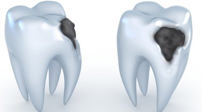 Боляче лікувати карієс: чи можна видаляти частину зуба без уколу, анестезія при лікуванні