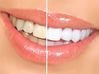 Ультразвукове відбілювання зубів: самий безболісний спосіб чищення ультразвуком