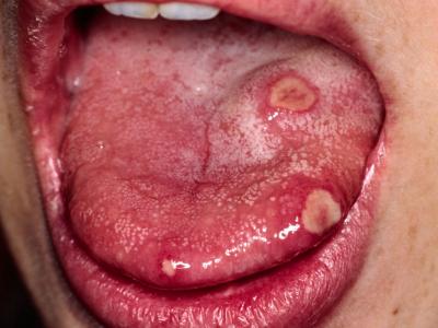 Антибіотики при стоматиті у дорослих: після лікування захворювань порожнини рота, лікується, чи потрібно пити ліки, можна лікувати