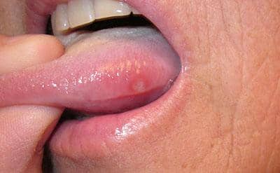 Перекис водню при стоматиті у дорослих, лікування полосканням, як полоскати рот, можна обробляти у дітей