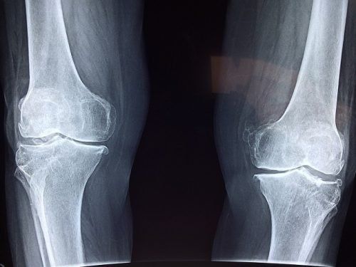 Симптоми, діагностика та терапія артриту колінного суглоба