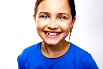 В якому віці ставити брекети дитині, зі скількох років можна дітям, скільки потрібно поставити на зуби, що краще носити