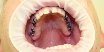 Імпланти жувальних зубів корінних: що це, як виглядають, плюси, мінуси зубного лікування, чим небезпечні керамічні, тимчасові види