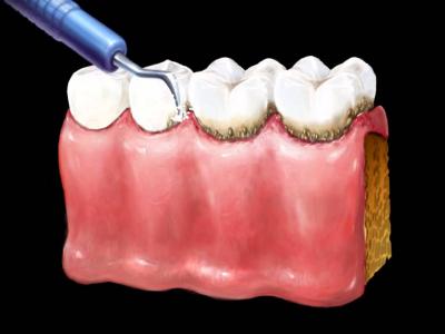 Зняття зубного каменю ультразвуком: як проводять ультразвукову чистку зубів від нальоту, чи боляче робити видалення відкладень