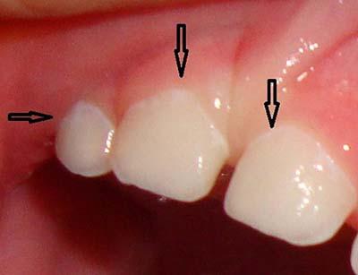 Карієс цементу зуба: клініка, діагностика, лікування, що таке в МКБ 10