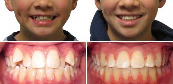 Брекети до і після лікування кривих зубів, результати посмішки на фото по місяцях, відчуття при носінні, вирівнюванні і установці