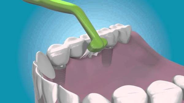 Догляд за імплантами зубів після установки: як доглядати за порожниною рота, як чистити іригатором після операції імплантації