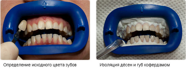 Відбілювання зубів Zoom 4 і 3, вартість системи Зум в клініці, як виглядає емаль після процедури, використання апарату Philips
