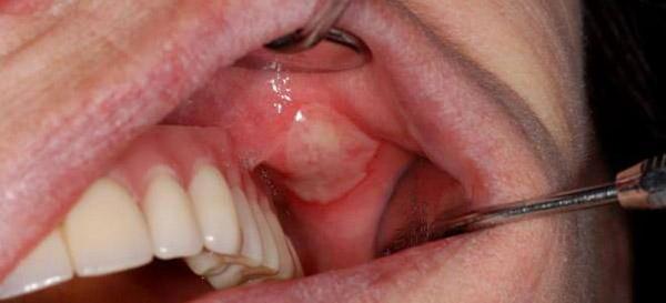 Стоматит фото на десні в роті у дорослих: що це таке, лікування опухлих ясен, чим і як лікувати, від чого зявляється запалення