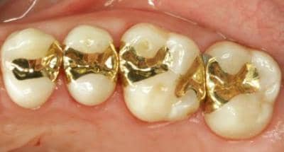 Фісурний карієс: що це, потрібно лікувати зуби, герметизація як профілактика, апарат для діагностики Аверон, лікування фісур