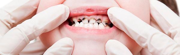 Причини карієсу у дітей, симптоми виникнення у молочних зубів