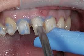 Видалення зубного каменю. Як видаляють зубний камінь, чи боляче це?