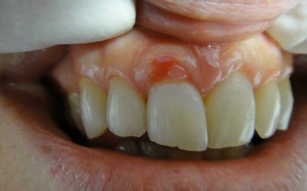 Хронічний періодонтит: код МКХ 10, симптоми, видалення зуба, диференційна діагностика, клініка, гострий свищ, що це, форми