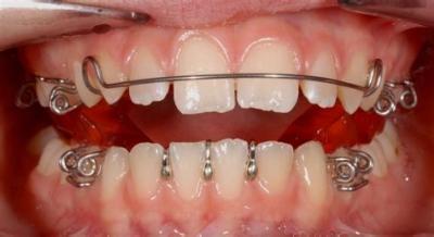 Чим відрізняються брекети від скоб: у чому різниця і які ортодонтичні системи краще