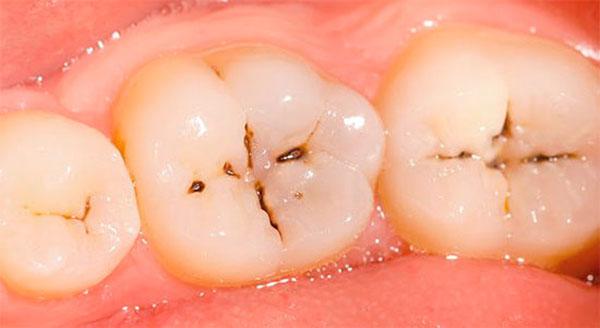 Карієс всередині зуба: причини внутрішнього запалення, як лікувати зсередини