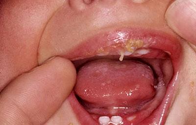 Стоматити у дітей: лікування, причини частого виникнення, від чого буває у дитини, із за чого зявляється у роті, звідки береться