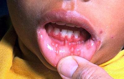 Стоматити у дітей: лікування, причини частого виникнення, від чого буває у дитини, із за чого зявляється у роті, звідки береться