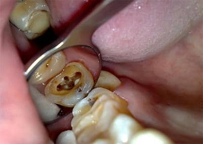 Пульпіт зуба мудрості: що це таке, симптоми хвороби, лікувати або видаляти?