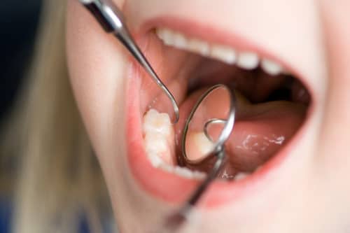 Профілактика карієсу зубів. Засоби і методи профілактики карієсу.