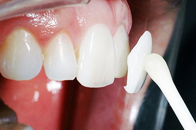 Виправлення прикусу вінірами: фото до і після, чи можна виправити неправильні криві зуби, відновлення висоти при стертості